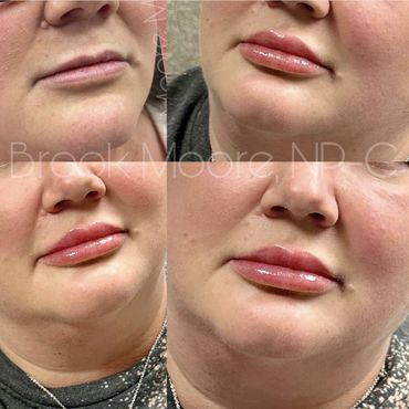 female patient's face before and after filler