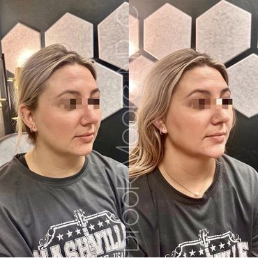 female patient's face before and after filler