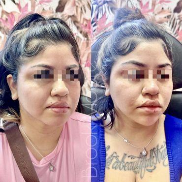 female patient's face before and after filler