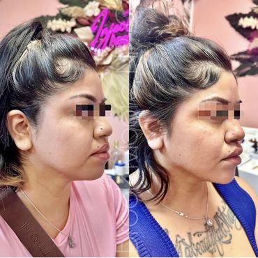 female patient's face before and after filler