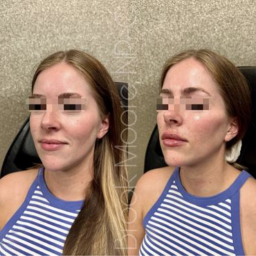 female patient's face before and after filler