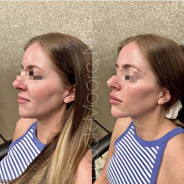 female patient's face before and after filler