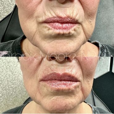 female patient's face before and after filler