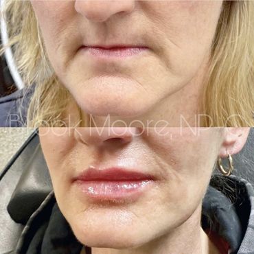 female patient's face before and after filler