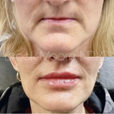 female patient's face before and after filler
