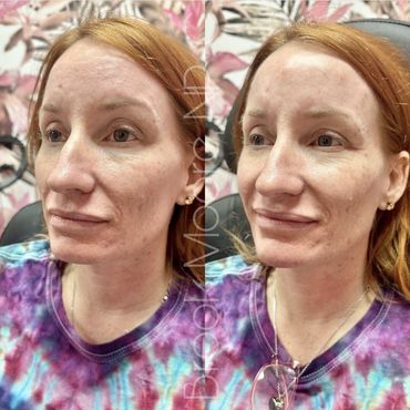 female patient's face before and after filler