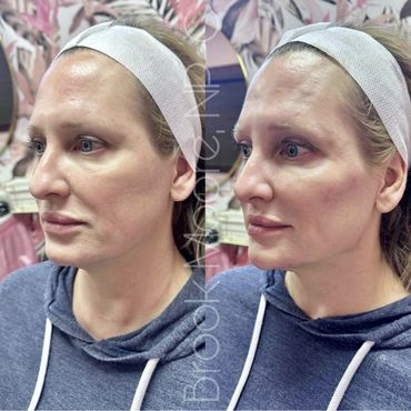 female patient's face before and after filler