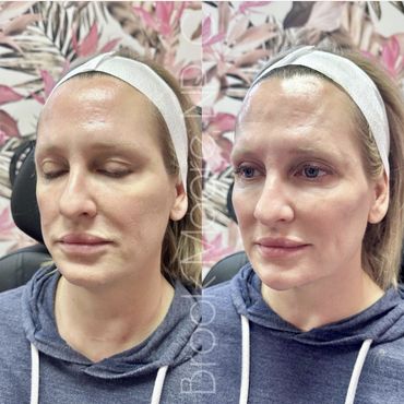 female patient's face before and after filler