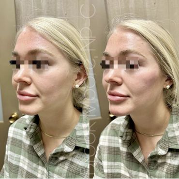 female patient's face before and after filler