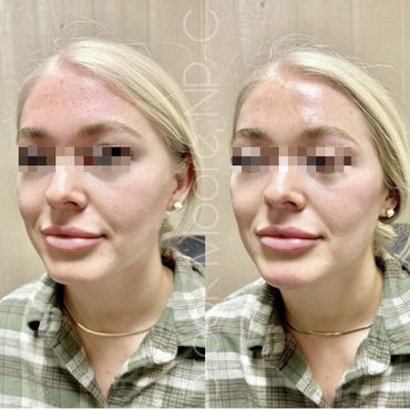 female patient's face before and after filler