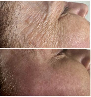 Close-up comparison of facial skin before and after treatment showing reduced wrinkles.