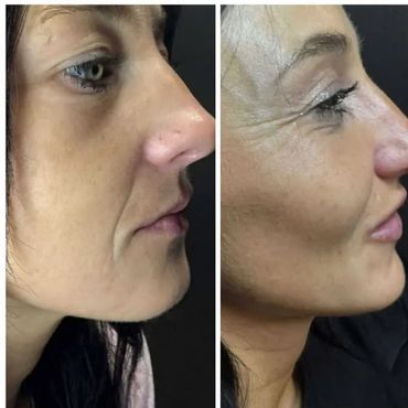 Side-by-side comparison of a woman's face showing skin texture and wrinkle differences.