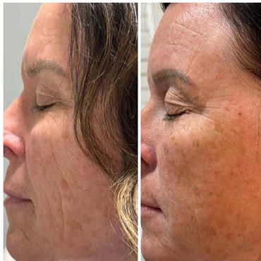 Side-by-side comparison of a woman's face showing skin texture and wrinkles.