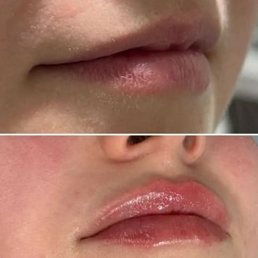 Close-up before and after lip enhancement showing natural to glossy lips.