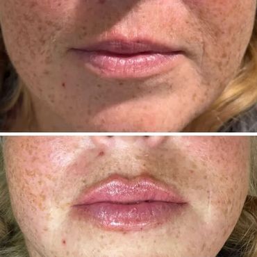 Close-up of lips before and after treatment showing fuller, shinier lips in the after image.