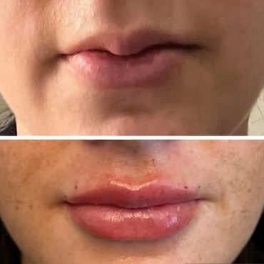 Close-up of lips before and after enhancement with fuller, glossier appearance.