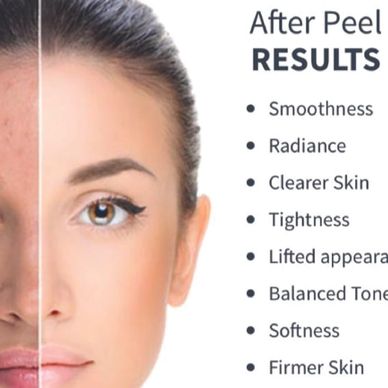 Benefits of a facial peel