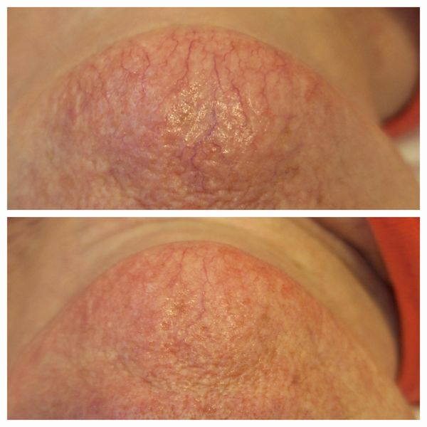 Cutera, Limelight, IPL, Rejuvenation, Pigmentation, Vascular Treatments, Broken capillaries