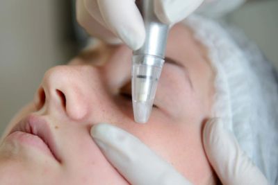 Microdermabrasion treatment in client