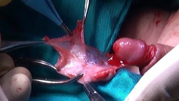 Another normal penis being cut up due to circumcision.