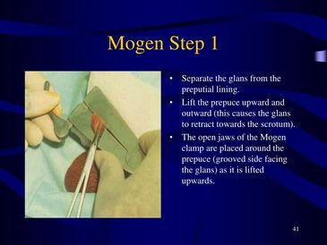 Another healthy baby undergoing genital cutting surgery for little or no valid reason.