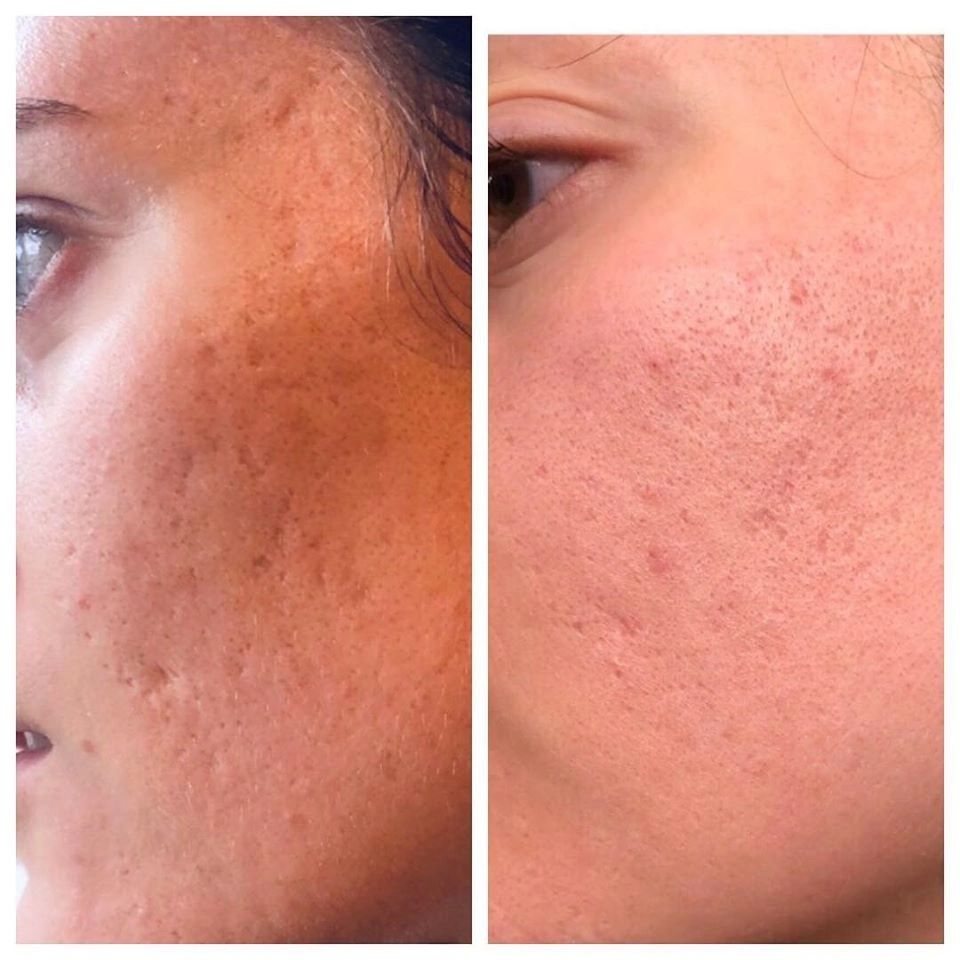 This lovely young woman had a very noticeable reduction in scarring after just 3 treatments!