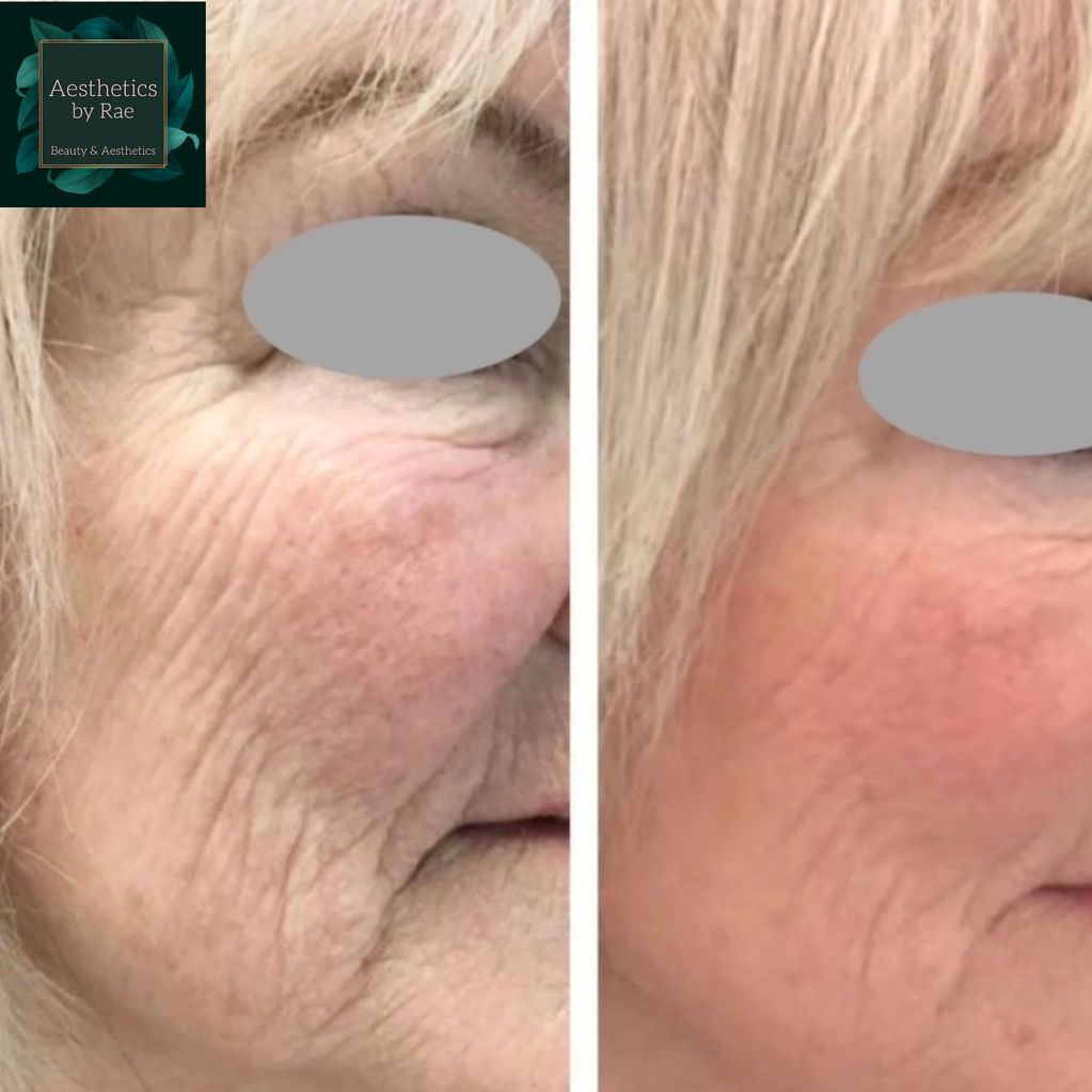 Before and after 3 sessions of Polynucleotides