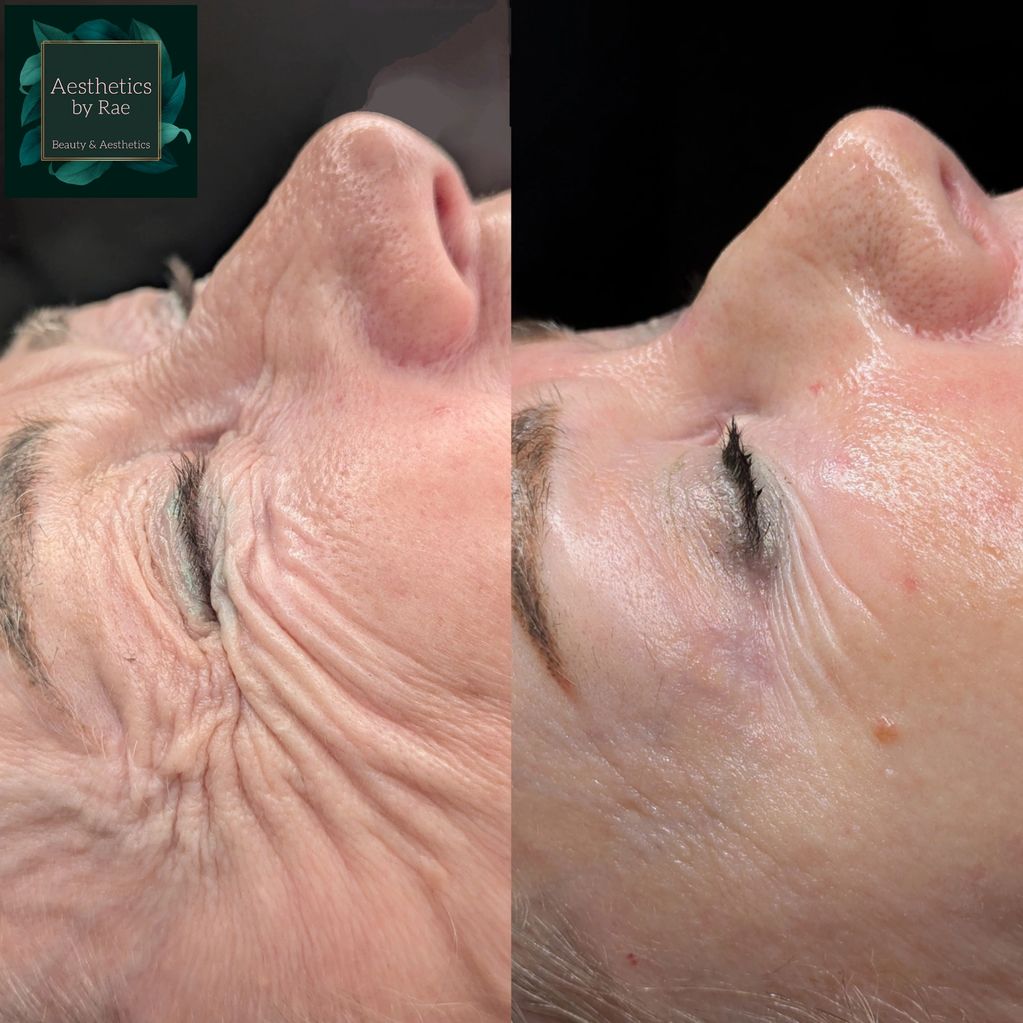 Before and after Botox for crows feet