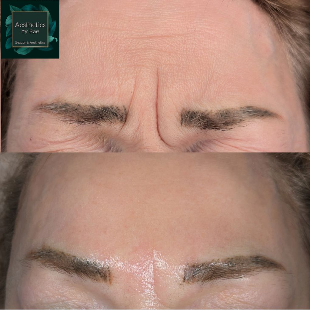 Before and after Botox for frown lines