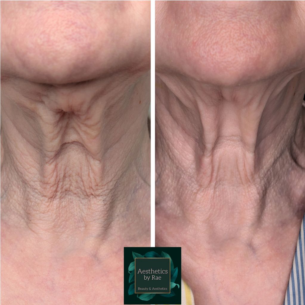 Before and after 3 sessions of Polynucleotides