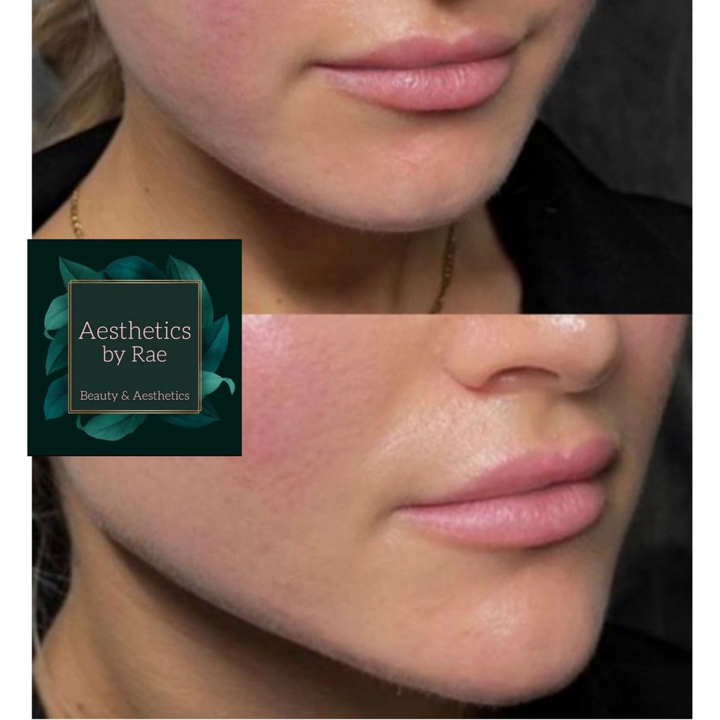 Before and after of chin filler