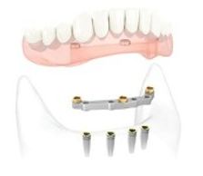 Implant bar over-denture 