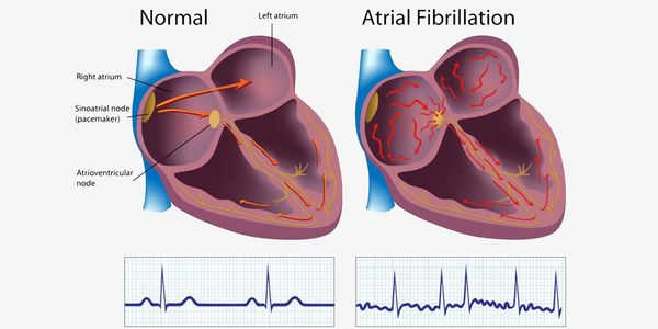 Atrial Fibrillation
Dr. Gianluigi Bisleri
Cardiac Surgery
Minimally Invasive Heart