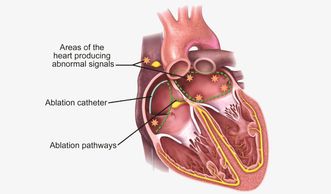 Hybrid Ablation
Dr. Gianluigi Bisleri
Atrial Fibrillation
Minimally Invasive Heart
