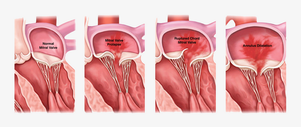 Mitral Regurgitation
Valve
Prolapse
Ruptured Chord
Annulus Dilatation
Minimally Invasive Heart