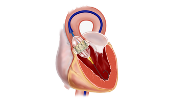 Transcatheter Aortic Valve Implantation (TAVI)
Prosthetic Sutureless Valve
Minimally Invasive Heart
