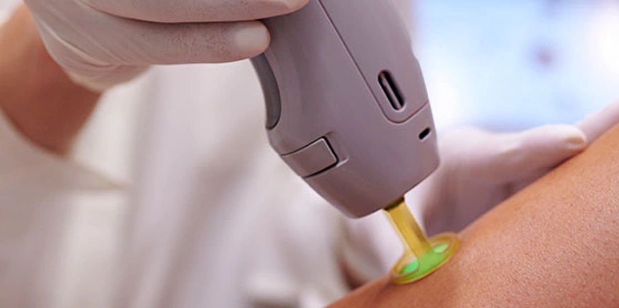 Laser hair removal procedure on skin.