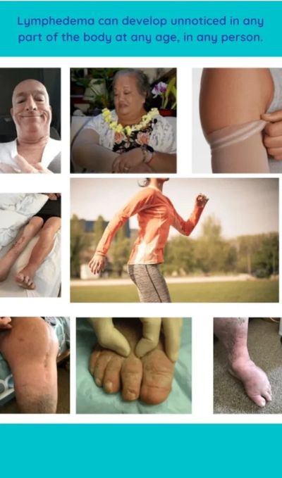 Various images show lymphedema affecting different body parts in people of all ages.