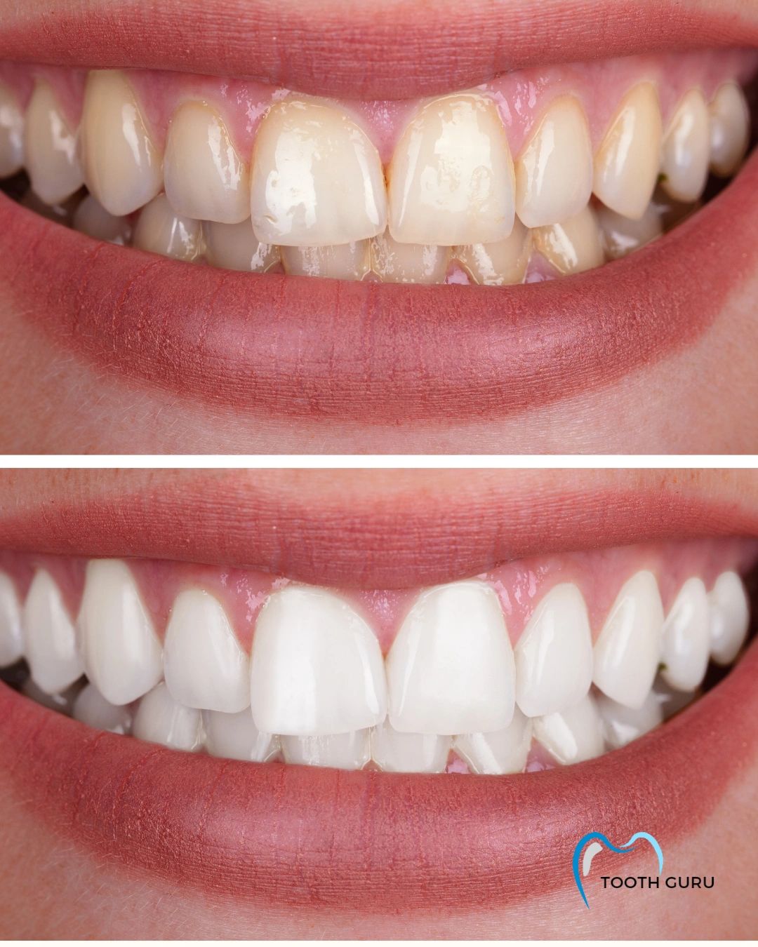 Close-up comparison of stained teeth before and bright white teeth after whitening treatment.