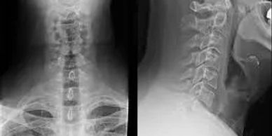 Cervical X-Rays
