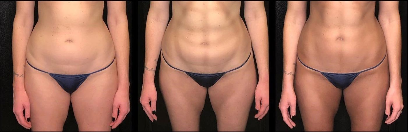Sunless body contouring