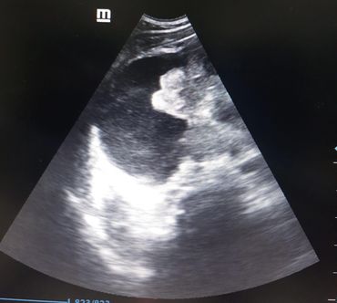 Ultrasound guided hydrostatic reduction for intussusception image
