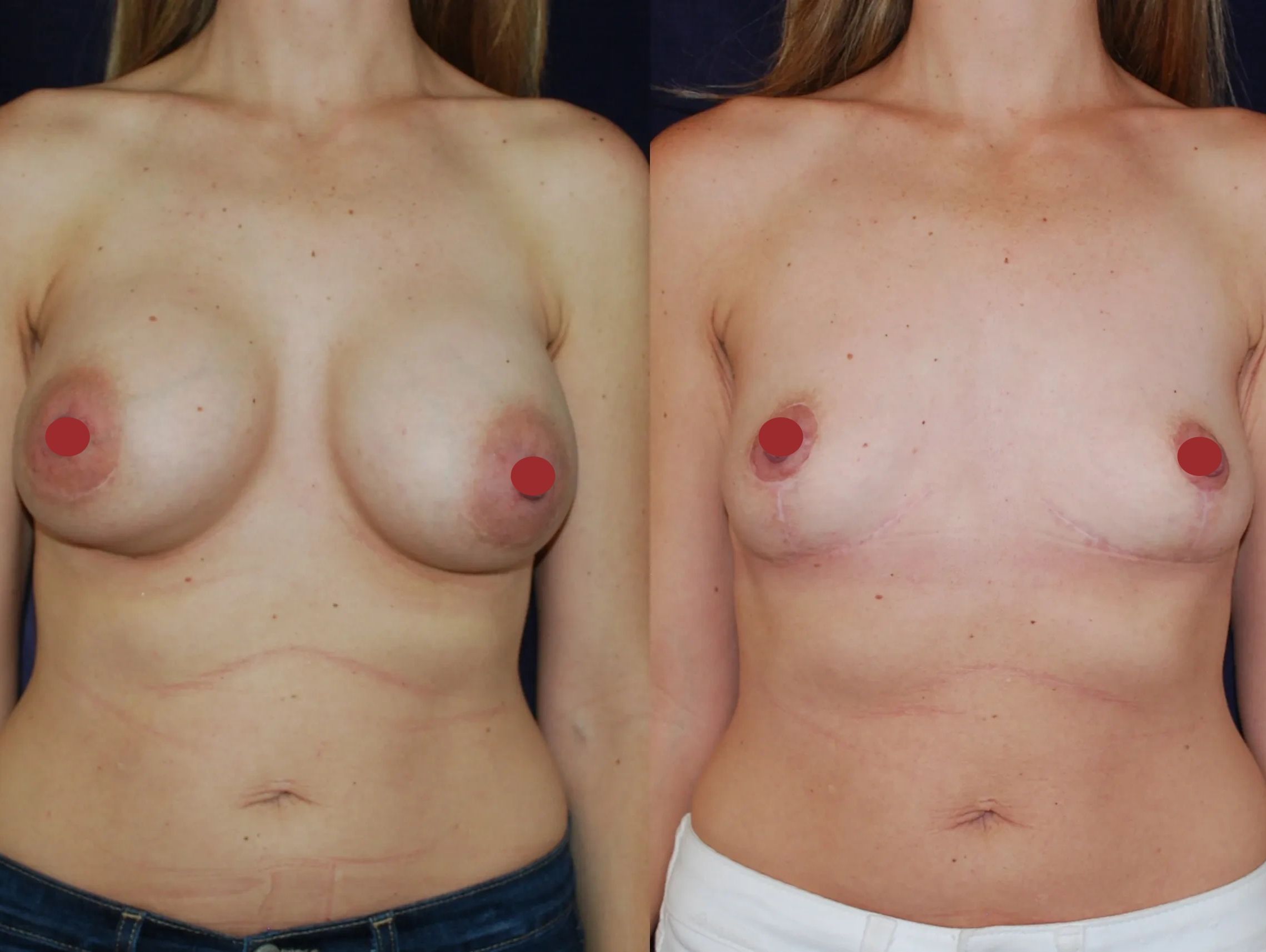 Before and after picture of breast implant removal and mastopexy.