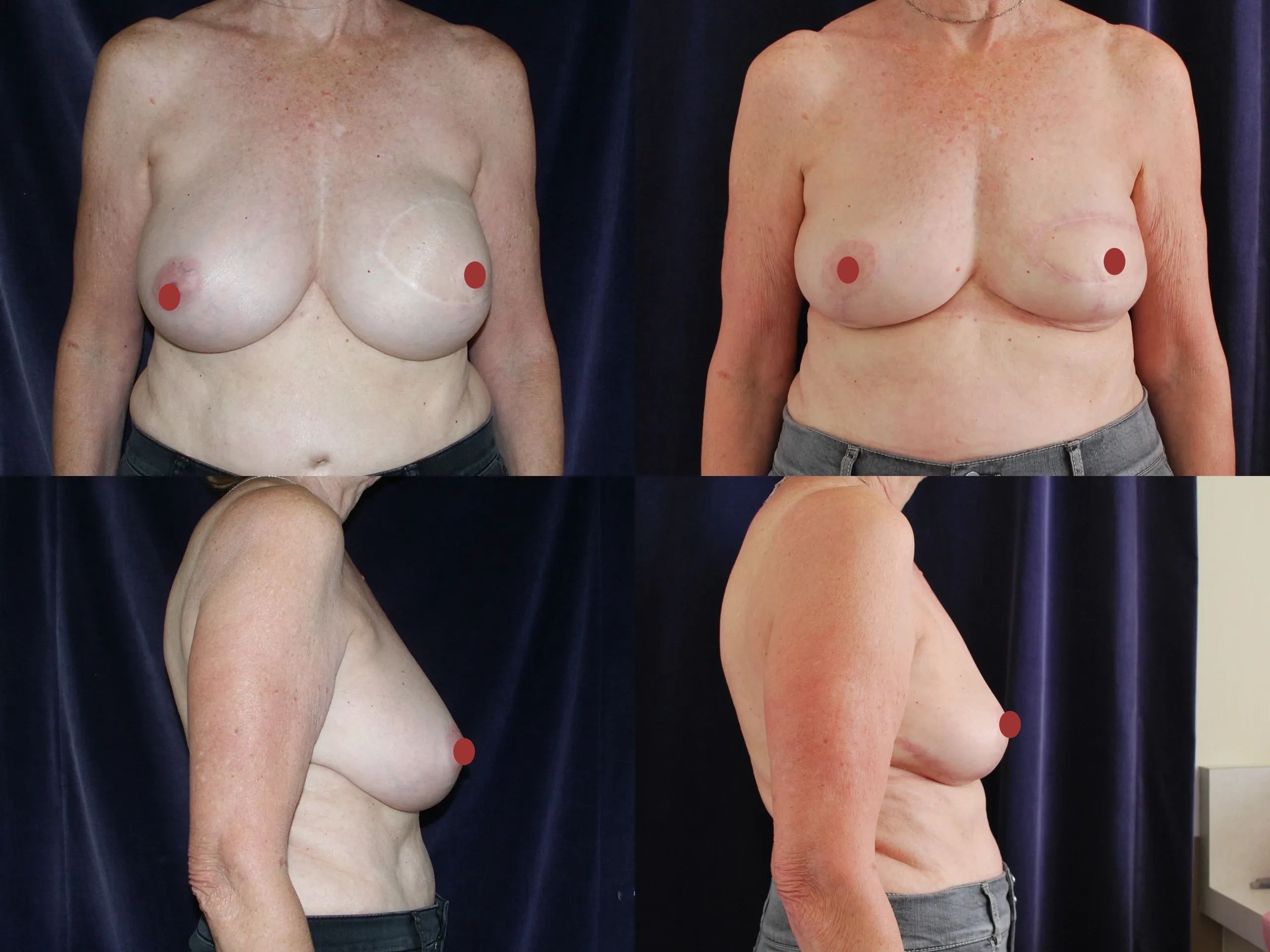 Before and after picture of breast implant removal and mastopexy.