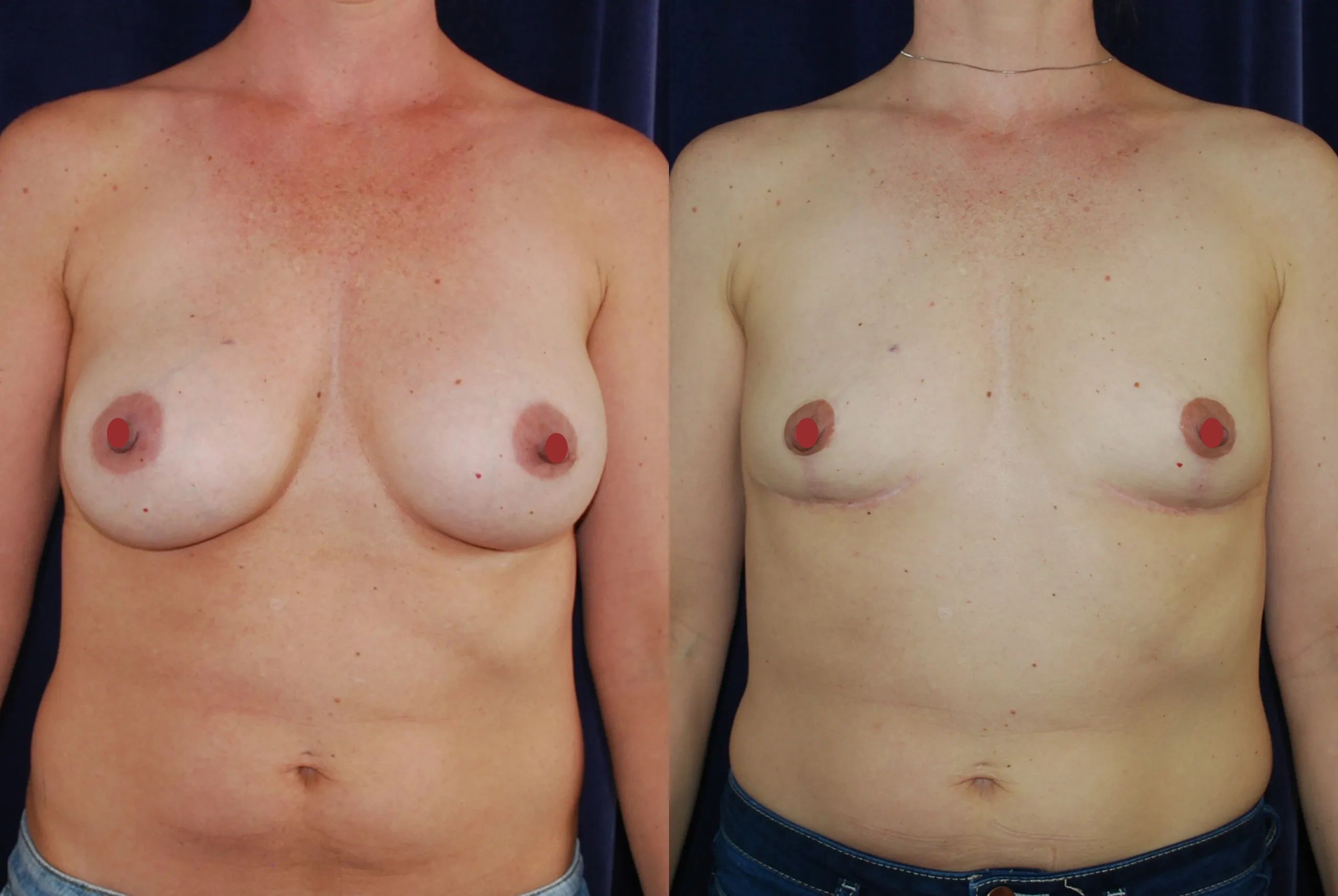 Before and after picture of breast implant removal and mastopexy.