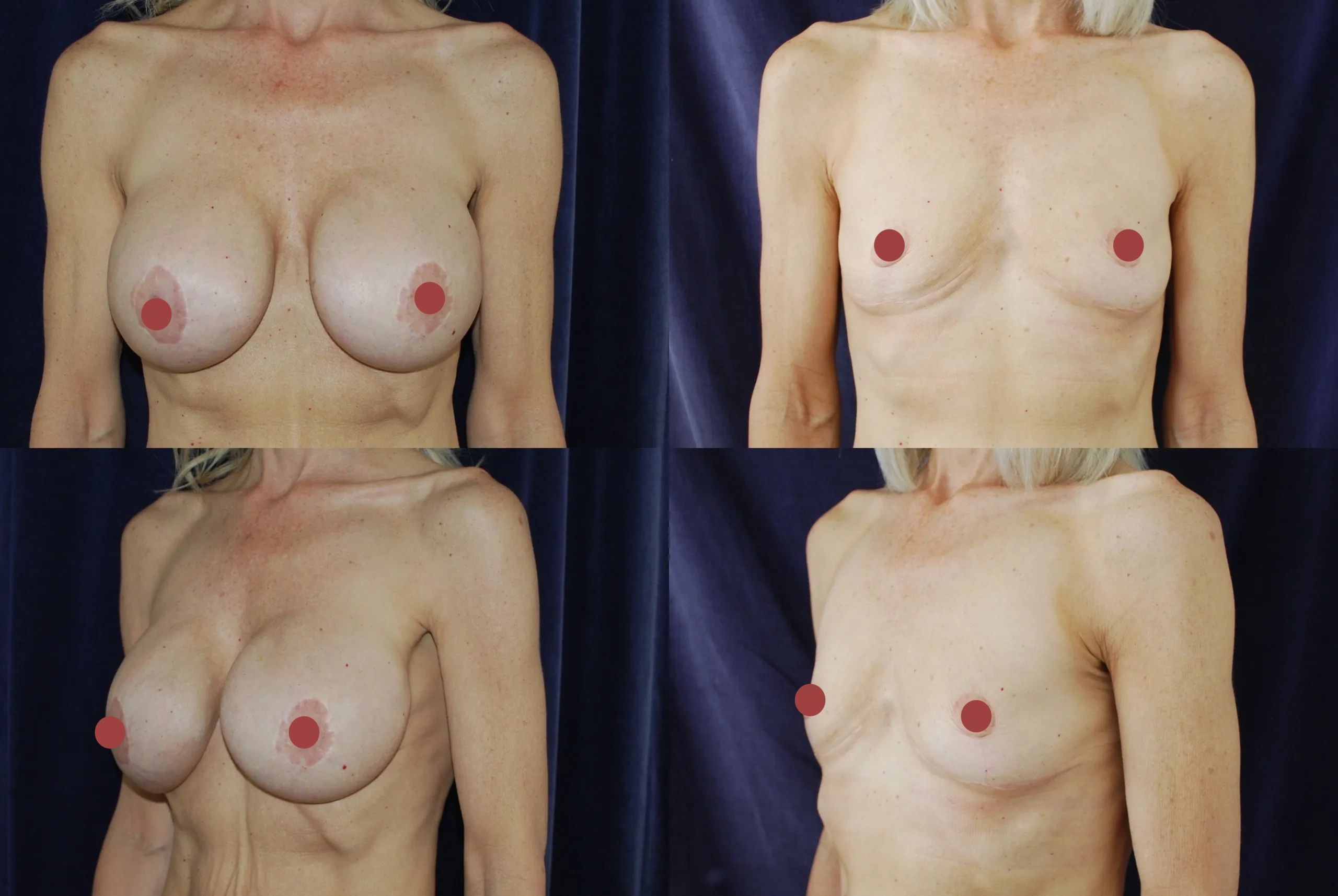 Before and after picture of breast implant removal and mastopexy.