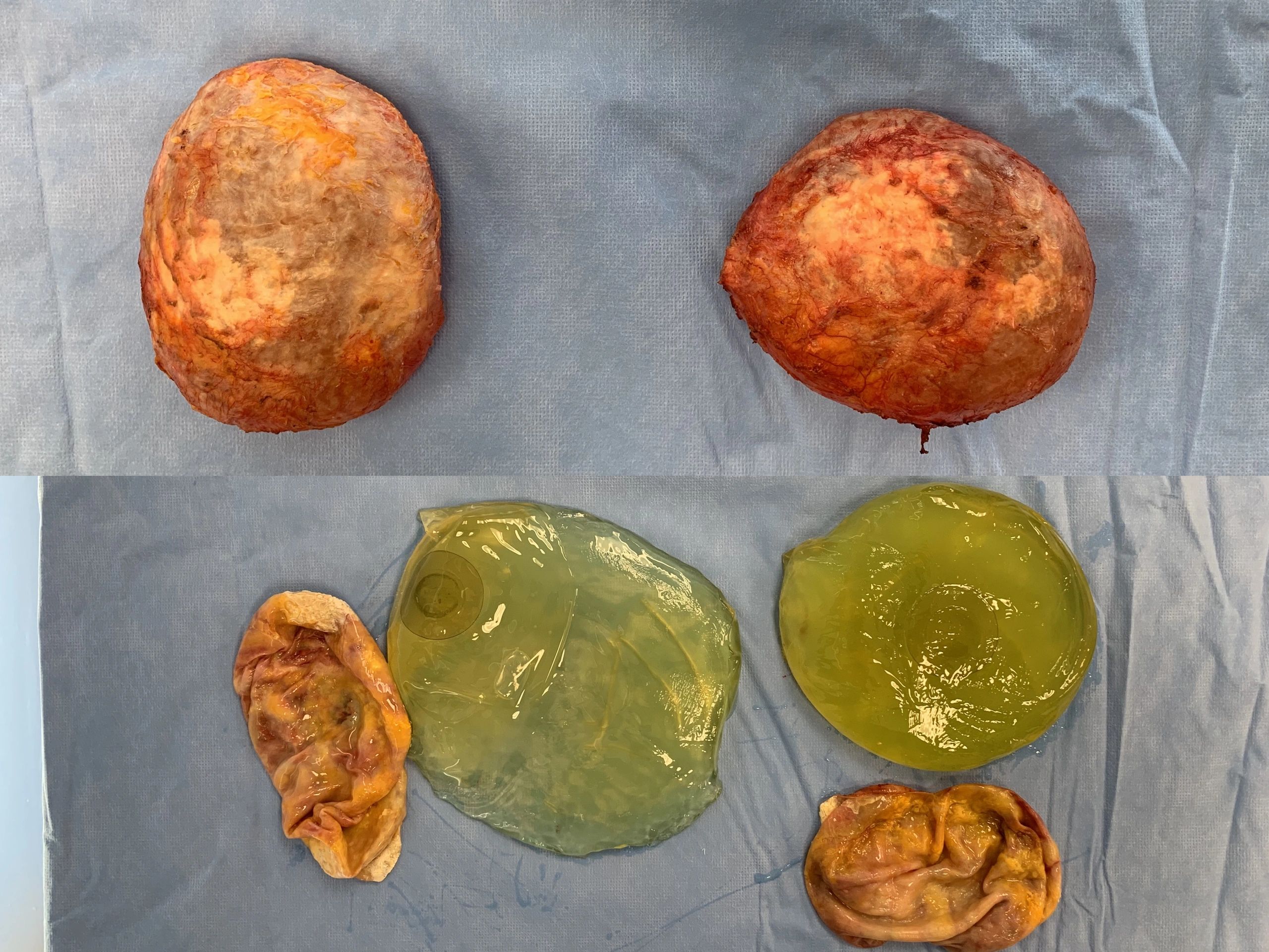 Picture of removed implants and capsules.