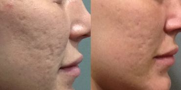 MICRONEEDLING COLLAGEN INDUCTION BENEV STEM CELL EXOSOMES PRP VAMPIRE FACIAL
