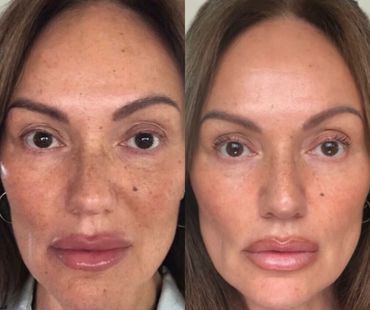 a multi modal approach to skin health and function stimulating collagen combining nctf aND MICRONEED