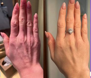 skin booster treatment showing improved skin texture and hydration on the hands